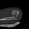 SPORK, NICO - 22.03.1976 - 02.08.2022 - CT obere Extremität - 18:02:23